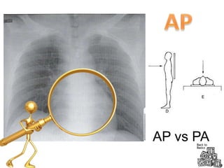 Appa Raddiology Chest Radiograph for Interns | PPTX