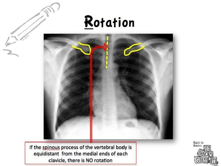 Chest Radiograph for Interns