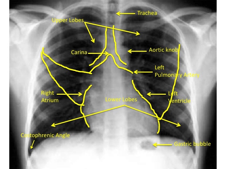Chest Radiograph for Interns