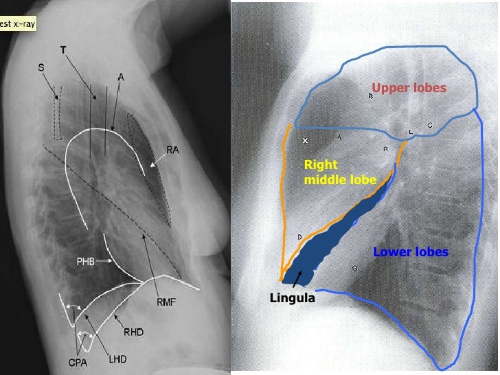 Chest Radiograph for Interns