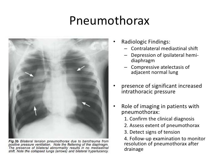 Chest Radiograph for Interns