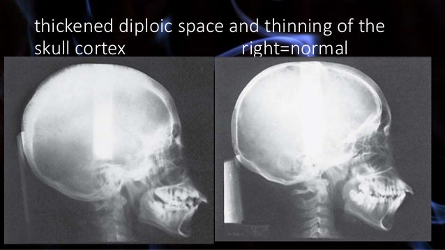 Systemic Diseases Manifested in the Jaws