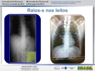 Raios-x nos leitos
Marcelo Henrique F. Lemos
TR.Radiodiagnóstico e Enfermeiro
Pós-Graduando em intensivismo
 