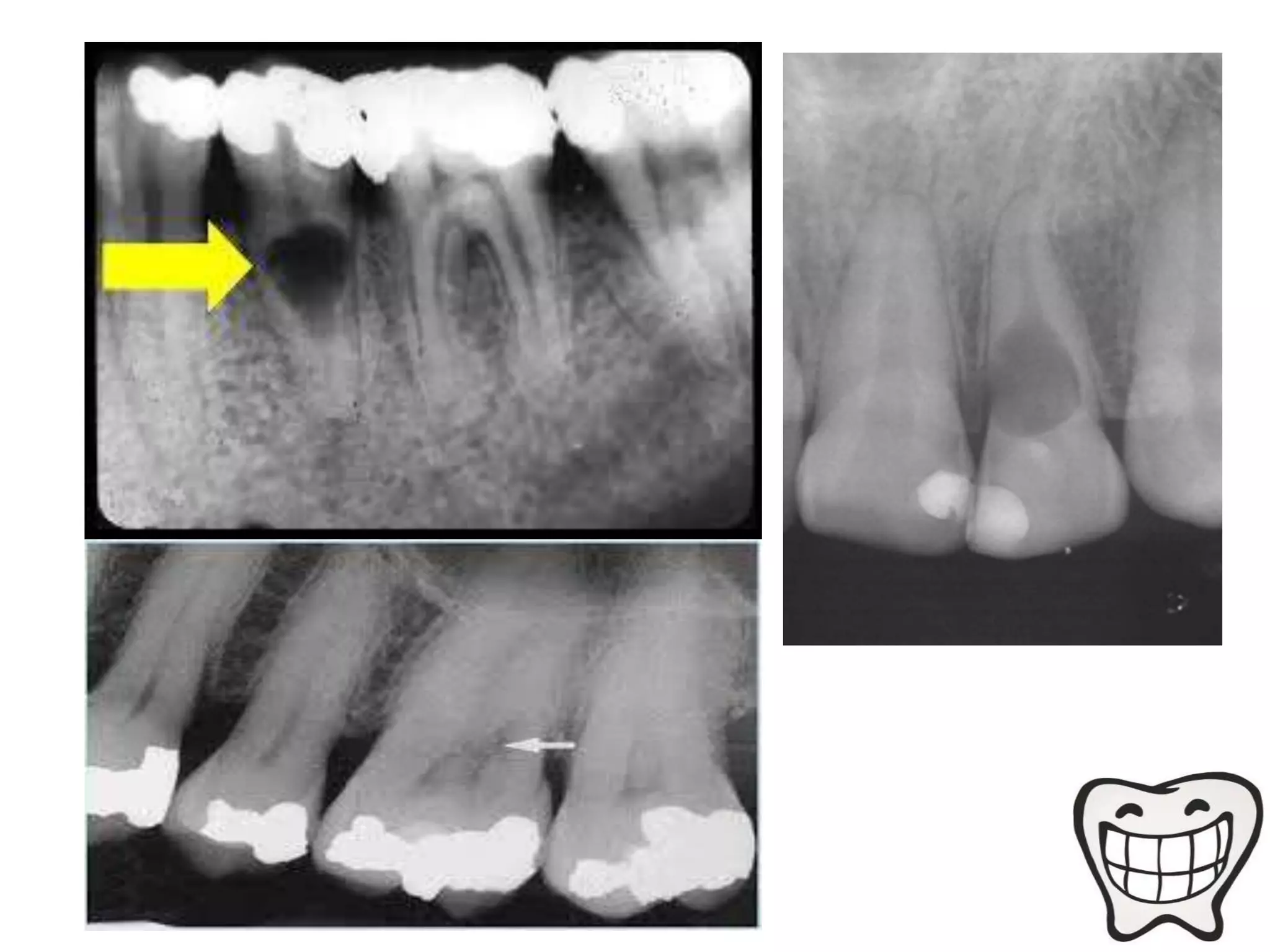 Pulp Radiograph Radio pulp diseases | PPTX