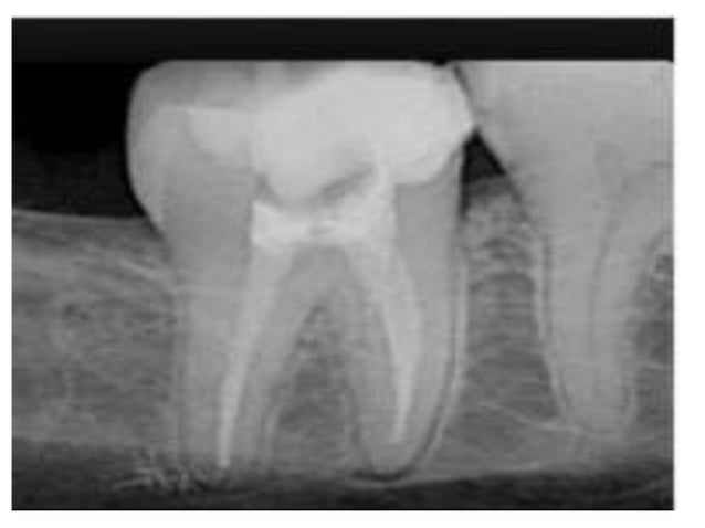Radio pulp diseases | PPTX | Dental Health | Diseases and Conditions