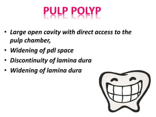 • Large open cavity with direct access to the
pulp chamber,
• Widening of pdl space
• Discontinuity of lamina dura
• Widening of lamina dura
 