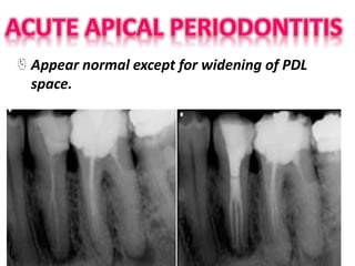 Appear normal except for widening of PDL
space.
 