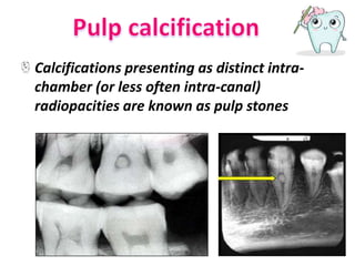 Calcifications presenting as distinct intra-
chamber (or less often intra-canal)
radiopacities are known as pulp stones
 