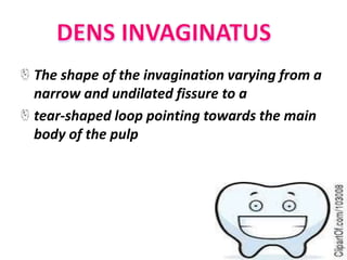 The shape of the invagination varying from a
narrow and undilated fissure to a
tear-shaped loop pointing towards the main
body of the pulp
 
