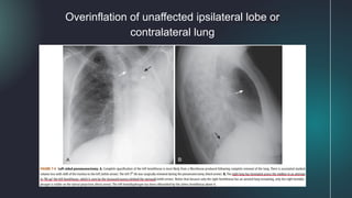 Overinflation of unaffected ipsilateral lobe or
contralateral lung
 