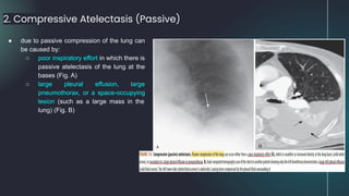 2. Compressive Atelectasis (Passive)
● due to passive compression of the lung can
be caused by:
○ poor inspiratory effort in which there is
passive atelectasis of the lung at the
bases (Fig. A)
○ large pleural effusion, large
pneumothorax, or a space-occupying
lesion (such as a large mass in the
lung) (Fig. B)
 