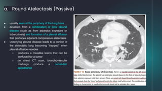 a. Round Atelectasis (Passive)
● usually seen at the periphery of the lung base
● develops from a combination of prior pleural
disease (such as from asbestos exposure or
tuberculosis) and formation of a pleural effusion
that produces adjacent compressive atelectasis
● underlying pleural disease leads to a portion of
the atelectatic lung becoming “trapped” when
pleural effusion recedes
○ produces a masslike lesion that can be
confused for a tumor
○ on chest CT scan, bronchovascular
markings produce a comet-tail
appearance
 