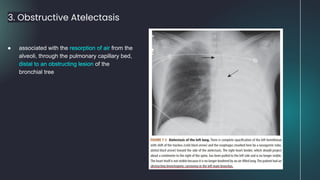 3. Obstructive Atelectasis
● associated with the resorption of air from the
alveoli, through the pulmonary capillary bed,
distal to an obstructing lesion of the
bronchial tree
 