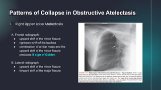 Patterns of Collapse in Obstructive Atelectasis
1. Right Upper Lobe Atelectasis
A. Frontal radiograph:
● upward shift of the minor fissure
● rightward shift of the trachea
● combination of a hilar mass and the
upward shift of the minor fissure
produces S sign of Golden
B. Lateral radiograph:
● upward shift of the minor fissure
● forward shift of the major fissure
 