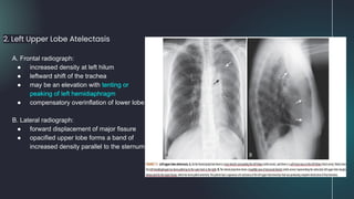 2. Left Upper Lobe Atelectasis
A. Frontal radiograph:
● increased density at left hilum
● leftward shift of the trachea
● may be an elevation with tenting or
peaking of left hemidiaphragm
● compensatory overinflation of lower lobe
B. Lateral radiograph:
● forward displacement of major fissure
● opacified upper lobe forms a band of
increased density parallel to the sternum
 