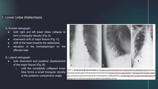 3. Lower Lobe Atelectasis
A. Frontal radiograph:
● both right and left lower lobes collapse to
form a triangular density (Fig. A)
● downward shift of major fissure (Fig. C)
● shift of the heart towards the atelectasis
● elevation of the hemidiaphragm on the
affected side
B. Lateral radiograph:
● both downward and posterior displacement
of the major fissure (Fig. B)
○ until the completely collapsed lower
lobe forms a small triangular density
at the posterior costophrenic angle
 