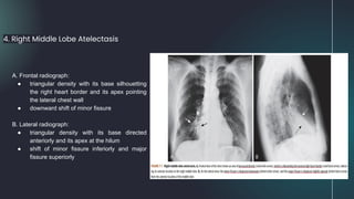 4. Right Middle Lobe Atelectasis
A. Frontal radiograph:
● triangular density with its base silhouetting
the right heart border and its apex pointing
the lateral chest wall
● downward shift of minor fissure
B. Lateral radiograph:
● triangular density with its base directed
anteriorly and its apex at the hilum
● shift of minor fissure inferiorly and major
fissure superiorly
 