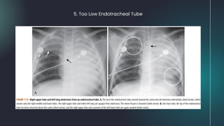 5. Too Low Endotracheal Tube
 