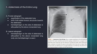 6. Atelectasis of the Entire Lung
A. Frontal radiograph:
● opacification of the atelectatic lung
● shift of all mobile thoracic structures towards
the atelectasis
● hemidiaphragm on the side of atelectasis is
silhouetted by the above nonaerated lung
B. Lateral radiograph:
● hemidiaphragm on the side of atelectasis is
silhouetted by the above nonaerated lung
(only one hemidiaphragm is seen)
 