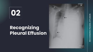 RECOGNIZING
PLEURAL
EFFUSION
02
Recognizing
Pleural Effusion
 