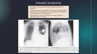 Dressler Syndrome
 