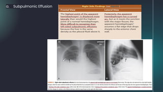 a. Subpulmonic Effusion
 