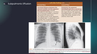 a. Subpulmonic Effusion
 