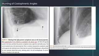 Blunting of Costophrenic Angles
 