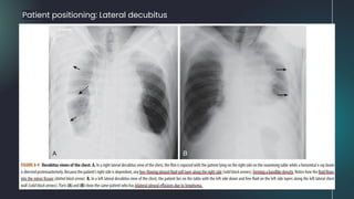 Patient positioning: Lateral decubitus
 