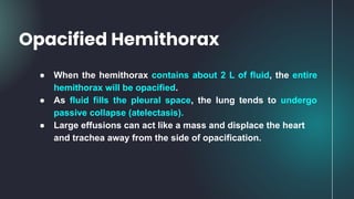 ● When the hemithorax contains about 2 L of fluid, the entire
hemithorax will be opacified.
● As fluid fills the pleural space, the lung tends to undergo
passive collapse (atelectasis).
● Large effusions can act like a mass and displace the heart
and trachea away from the side of opacification.
Opacified Hemithorax
 