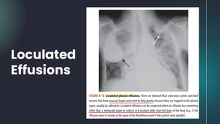 Loculated
Effusions
 