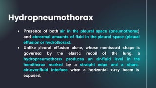 ● Presence of both air in the pleural space (pneumothorax)
and abnormal amounts of fluid in the pleural space (pleural
effusion or hydrothorax).
● Unlike pleural effusion alone, whose meniscoid shape is
governed by the elastic recoil of the lung, a
hydropneumothorax produces an air-fluid level in the
hemithorax marked by a straight edge and a sharp,
air-over-fluid interface when a horizontal x-ray beam is
exposed.
Hydropneumothorax
 