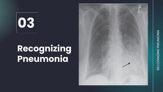 03
RECOGNIZING
PNEUMONIA
Recognizing
Pneumonia
 