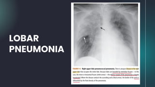LOBAR
PNEUMONIA
 