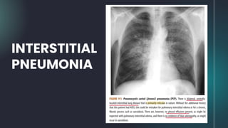 INTERSTITIAL
PNEUMONIA
 