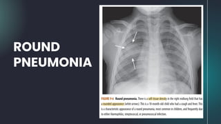 ROUND
PNEUMONIA
 