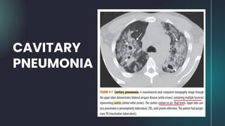 CAVITARY
PNEUMONIA
 