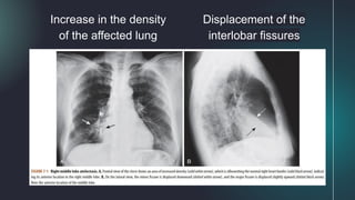 Increase in the density
of the affected lung
Displacement of the
interlobar fissures
 