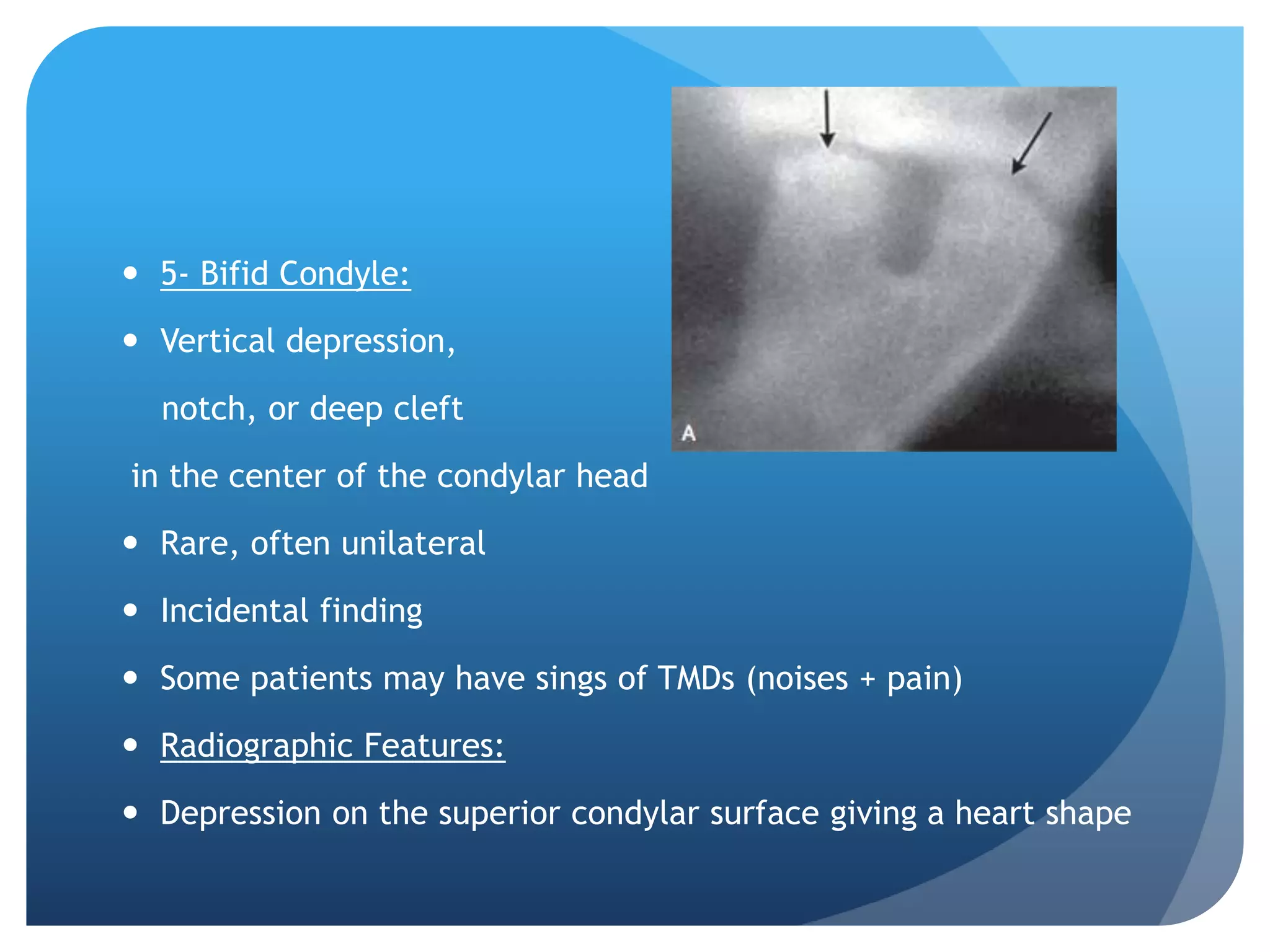  5- Bifid Condyle:

 Vertical depression,

  notch, or deep cleft

in the center of the condylar head

 Rare, often unilateral

 Incidental finding

 Some patients may have sings of TMDs (noises + pain)

 Radiographic Features:

 Depression on the superior condylar surface giving a heart shape
 