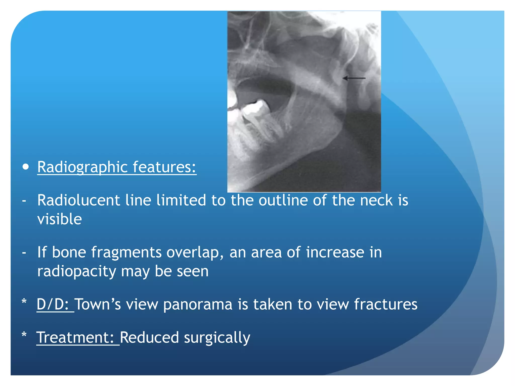  Radiographic features:

- Radiolucent line limited to the outline of the neck is
  visible

- If bone fragments overlap, an area of increase in
  radiopacity may be seen

* D/D: Town’s view panorama is taken to view fractures

* Treatment: Reduced surgically
 
