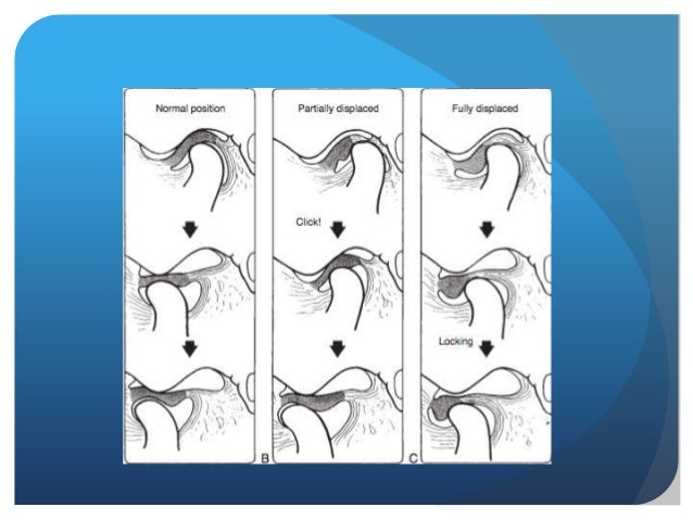 Tmj Deviation Deflection Tmj Subluxation Radiology – Ninnescah Township, Kingman County, Kansas ...