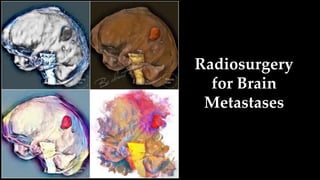 Radiosurgery
for Brain
Metastases
 