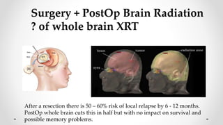 Radiosurgery for brain metastases