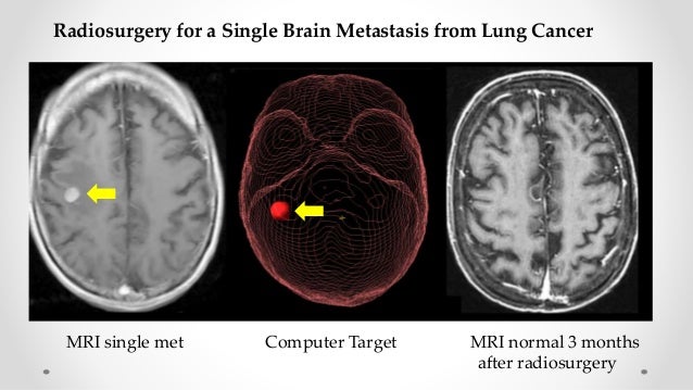 Brain Tumors And Lung Cancer - Brain Tumor Cancer