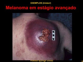 Melanoma em estágio avançado  Professor  Rodrigo Penna EXEMPLOS (tristes!) 
