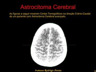 Astrocitoma Cerebral As figuras a seguir mostram Cortes Tomográficos na direção Crânio-Caudal de um paciente com Astrocitoma Cerebral avançado. Professor  Rodrigo Penna  www.fisicanovestibular.com.br   