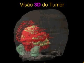 Visão  3D  do Tumor Professor  Rodrigo Penna 