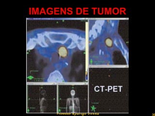 IMAGENS DE TUMOR Professor  Rodrigo Penna 