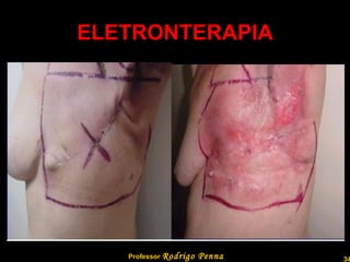 ELETRONTERAPIA Professor  Rodrigo Penna  www.fisicanovestibular.com.br   