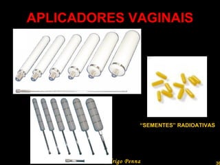 APLICADORES VAGINAIS Professor  Rodrigo Penna “ SEMENTES” RADIOATIVAS 
